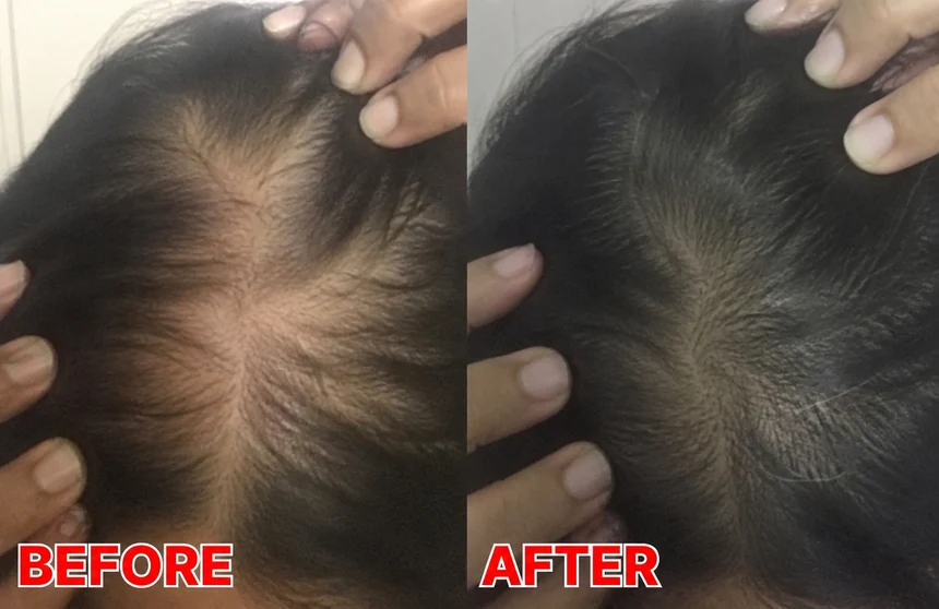 Hair density at the crown, before and after