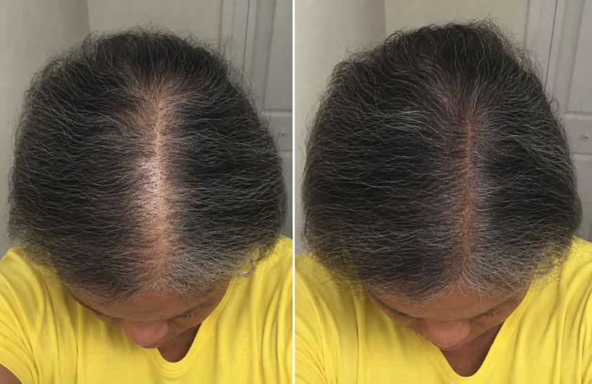 Hair density at the parting, before and after
