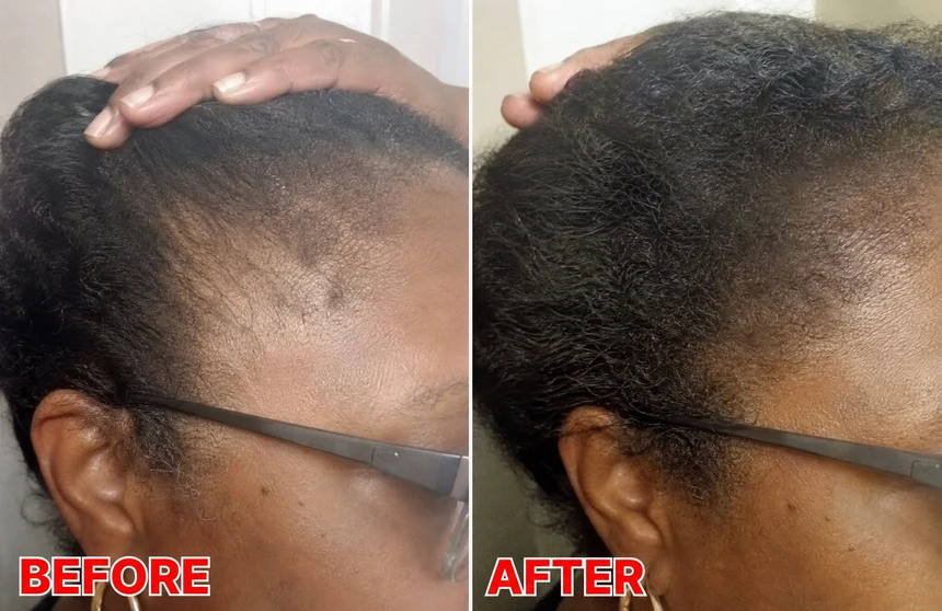 Hair density at the temples, before and after