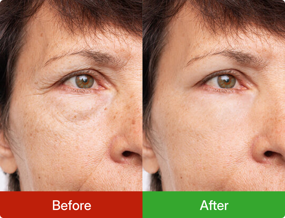 Before and after comparison of a woman's eye area with visible skin improvement.