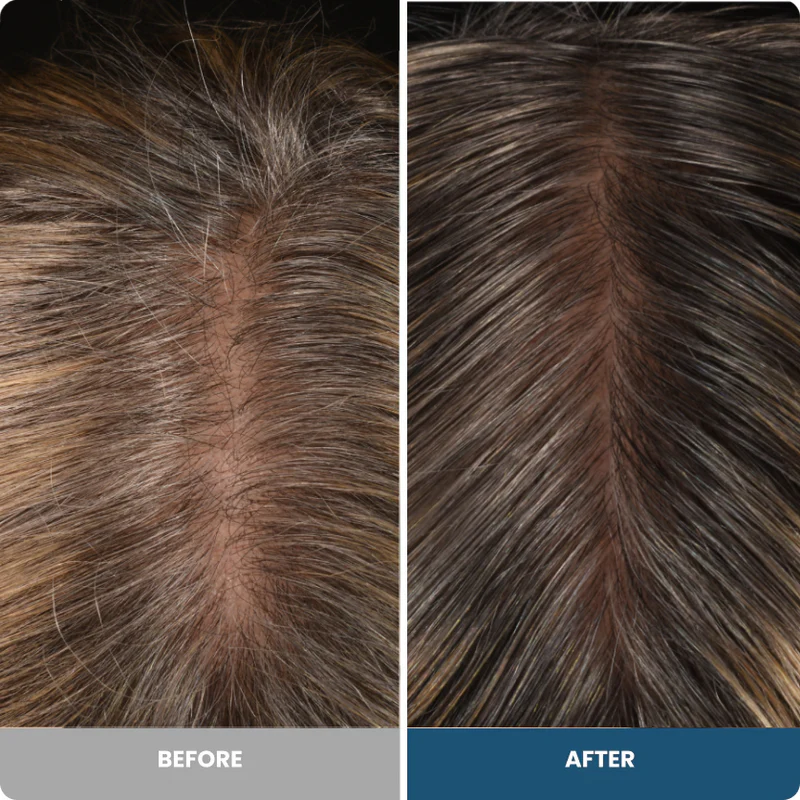 Before and after, left to right: top of scalp with a widened thinning part on the left and fuller hair with a narrower part on the right