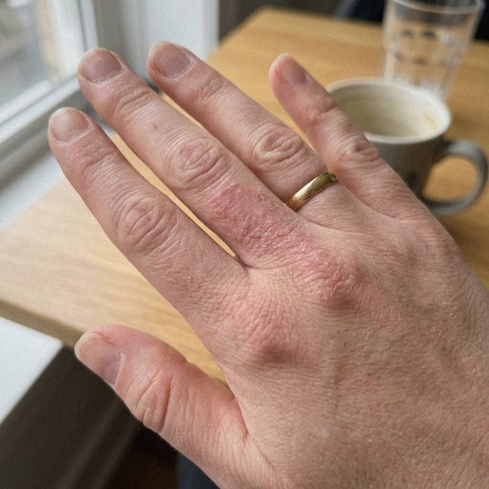 An eczema flare on the skin