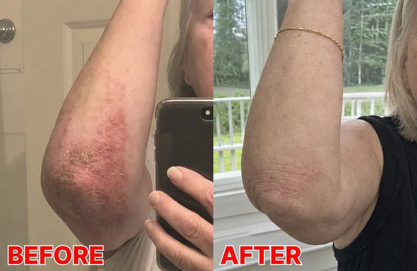 Before and after on the inner elbow