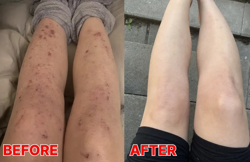 Before and after on the lower legs