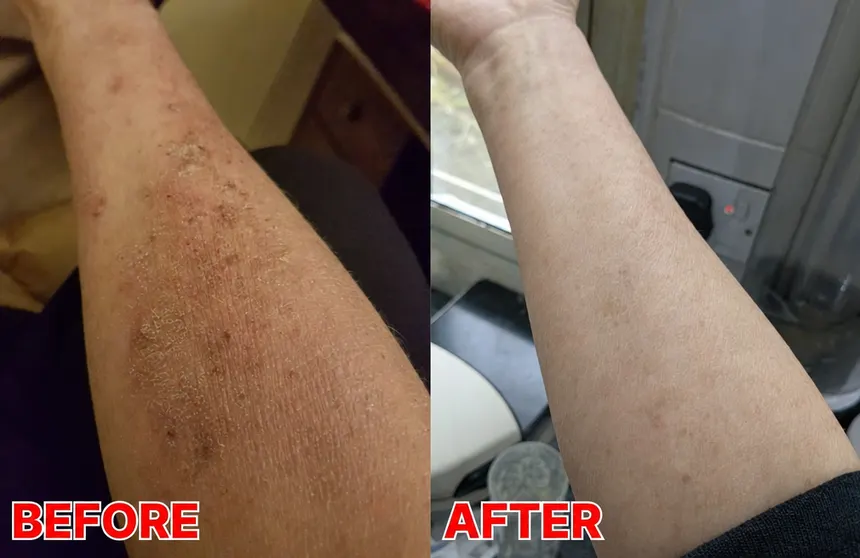 Before and after on the inner forearm