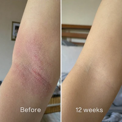 Active ReLeaf Spot Gel - Phoilex