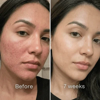 Active ReLeaf Spot Gel - Phoilex