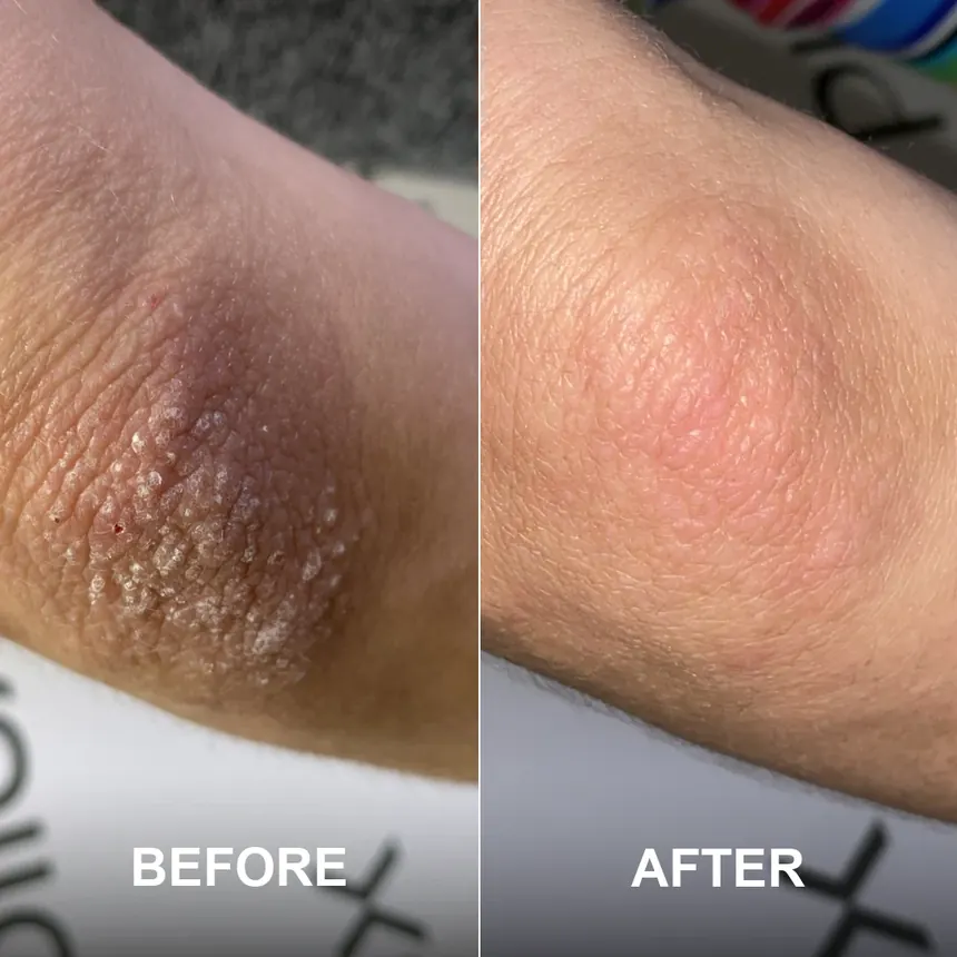 Active ReLeaf Spot Gel - Phoilex