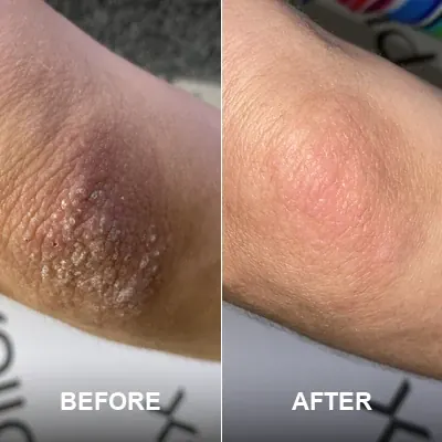 Active ReLeaf Spot Gel - Phoilex