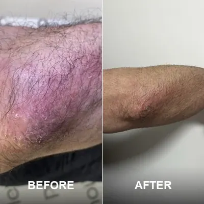 Active ReLeaf Spot Gel - Phoilex